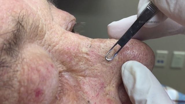 Don't miss these huge blackhead extractions in "The Fireman" смотреть онлайн