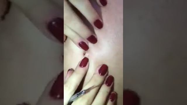 Очень большой прыщ. Very big pimple смотреть онлайн