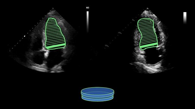Cardiac Mechanics (preload, afterload, contractility, ejection fraction, and cardiac output) смотреть онлайн