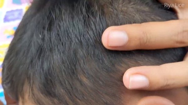 Remove lice from short hair - Taking out all lice from from black hair