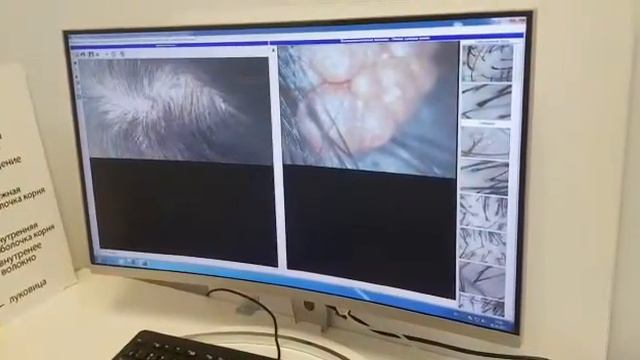 Невус смотреть онлайн