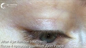 Полное удаление татуажа. Стрелки. До После. Full permanent makeup removal with Jet Remove