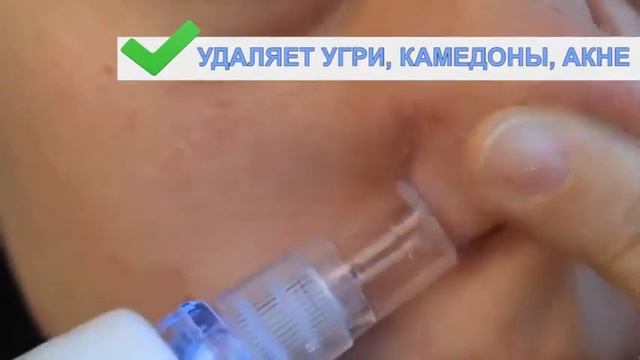 Вакуумный очиститель пор Spot Cleaner смотреть онлайн