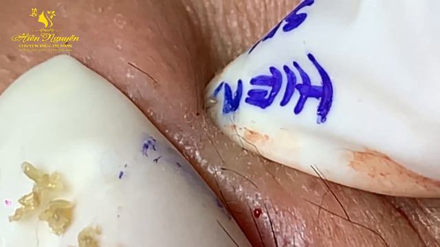 Satisfying Hien Spa Beauty Relaxing Video #14