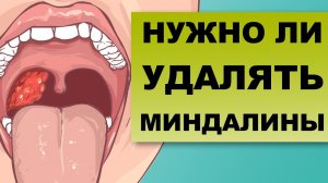 УДАЛЕНИЕ МИНДАЛИН. Операция Тонзиллэктомия.