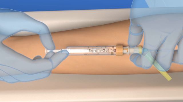 Blood collection: Vacuum with the S-Monovette® (ISO colour code) and Safety-Needle смотреть онлайн