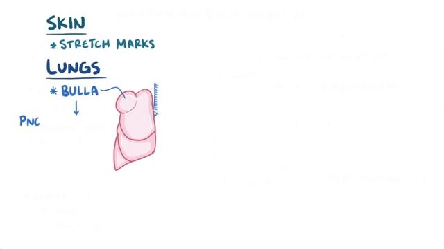 Marfan Syndrome - causes, symptoms, diagnosis, treatment, pathology смотреть онлайн