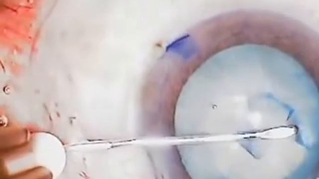 Capsulorhexis in HYPERMATURE milky white cataract By Dr Kamal Kapur смотреть онлайн
