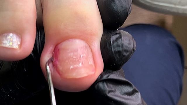 Динамика вросшего ногтя спустя месяц смотреть онлайн