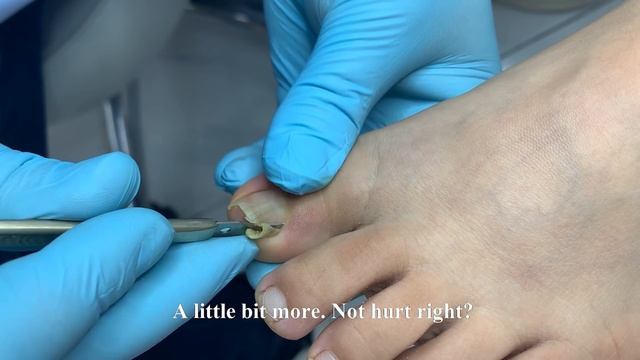 How to repair curled nail смотреть онлайн