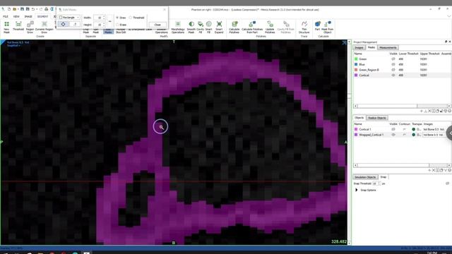 Developing a Mimics 3D Bone Model with Trabecular and Cortical Bone Separated (Prox Humerus Example смотреть онлайн