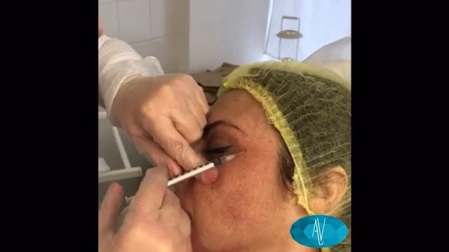 Устранение морщин вокруг глаз. Врач Алла Ветрова