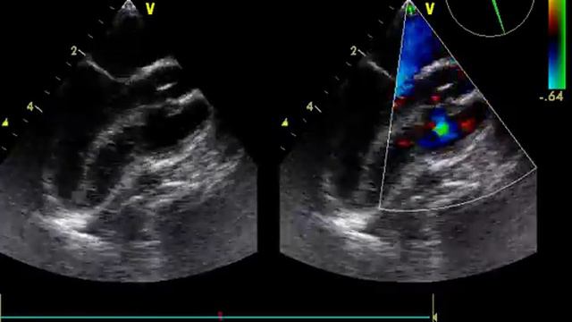 ДМЖП до установки окклюдера смотреть онлайн
