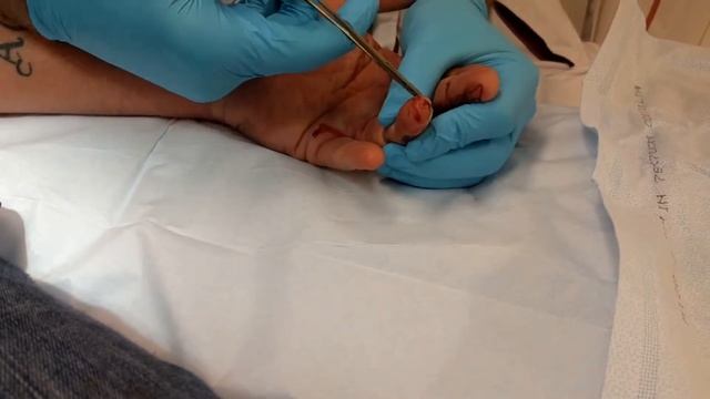 Ouch! Learn how to remove a huge fish hook from your finger! смотреть онлайн