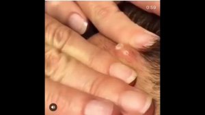 pipmle, Прыщ взорвался, Черные точки