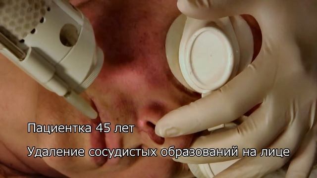 Скажи нет: купероз, сосуды, розацеа, звездочки! Лазер Friendlylight