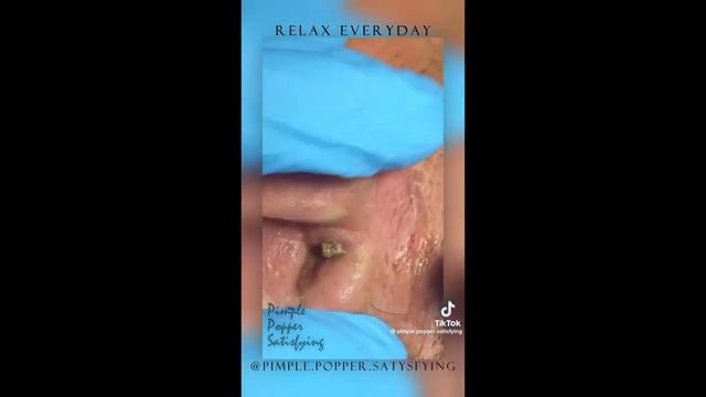 Ужасные прыщи на теле #акне #blackhead #acne #pimple смотреть онлайн