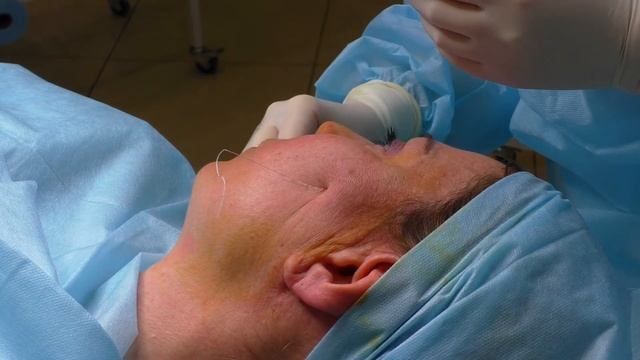 Лифтинг средней зоны лица  Реверсивная техника  Анкор макс