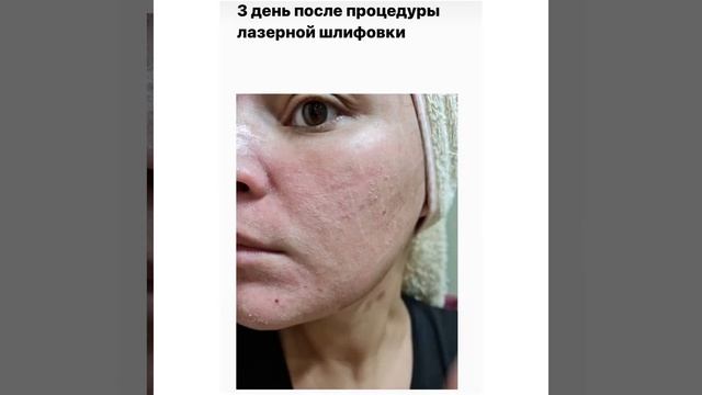 Лазерная шлифовка. Восстановление по дням. смотреть онлайн