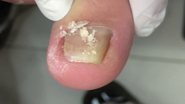 Crazy Toenail Growth, The Perfect Solution To Ingrown Toenails【Crazy Pedicure Room】