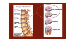 Лазерная реконструкция межпозвонковых дисков