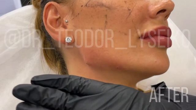 Jawline with filler. Presentation of video tutorial смотреть онлайн