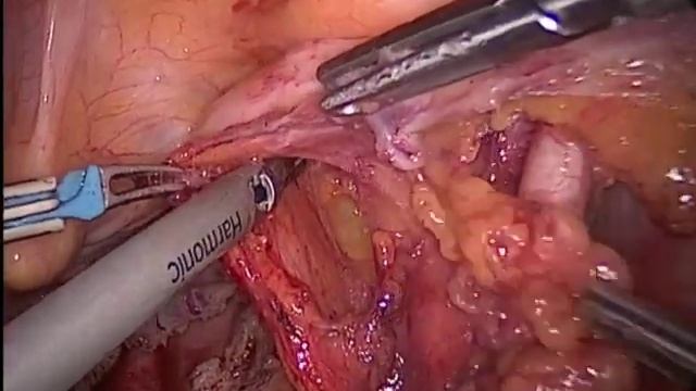 Endometrial Cancer: Laparoscopic staging surgery смотреть онлайн