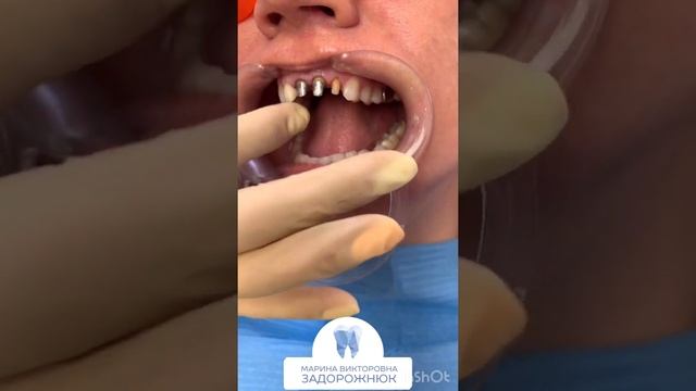 Примерка коронок Emax