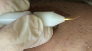 Электроэпиляция иглой