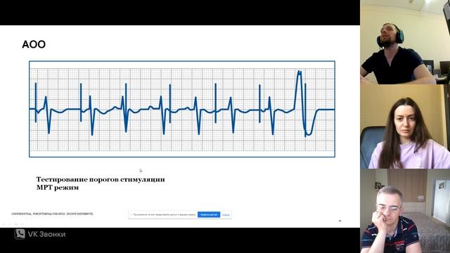 Разбор ЭКГ с ЭКС
