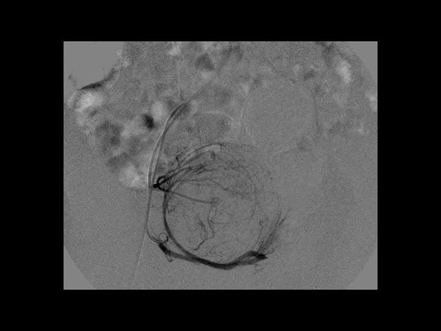 Subtraction angiography смотреть онлайн
