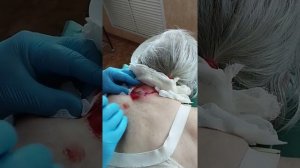 Удаление карбункула спины