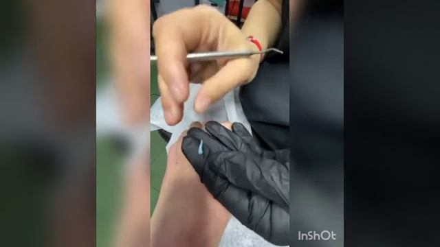 Доступные методики коррекции деформированных и вросших ногтей. Как помочь клиенту "без вложений". смотреть онлайн