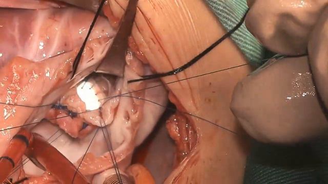 Osman Al-Radi: Complete AVSD Repair