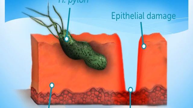 GIT PATHOLOGY LECTURE 5 - DR. SAAD MAROOF SAEED смотреть онлайн
