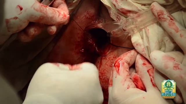 Лазерная геморроидэктомия. Смешанный геморрой. ДНМУ Нemorrhoidectomy