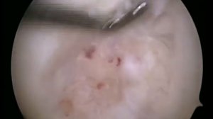 Артроскопическая картина остеохондрального дефекта медиального мыщелка бедра при болезни Кёнига
