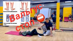 Вальгус. Исправление и профилактика.