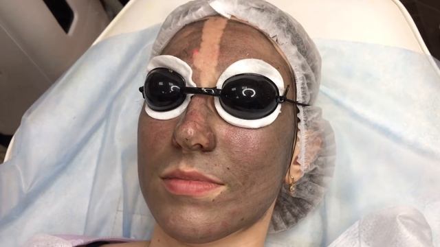 Карбоновый пилинг на Alfa plus смотреть онлайн