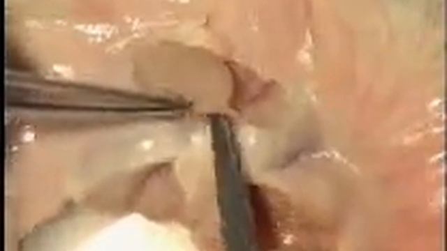 Lymph Node Dissection ~ Basic Surgical Skills (BSS) смотреть онлайн