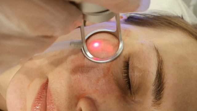 Лазерная шлифовка | Студия красоты «Эсте» в Таганроге смотреть онлайн