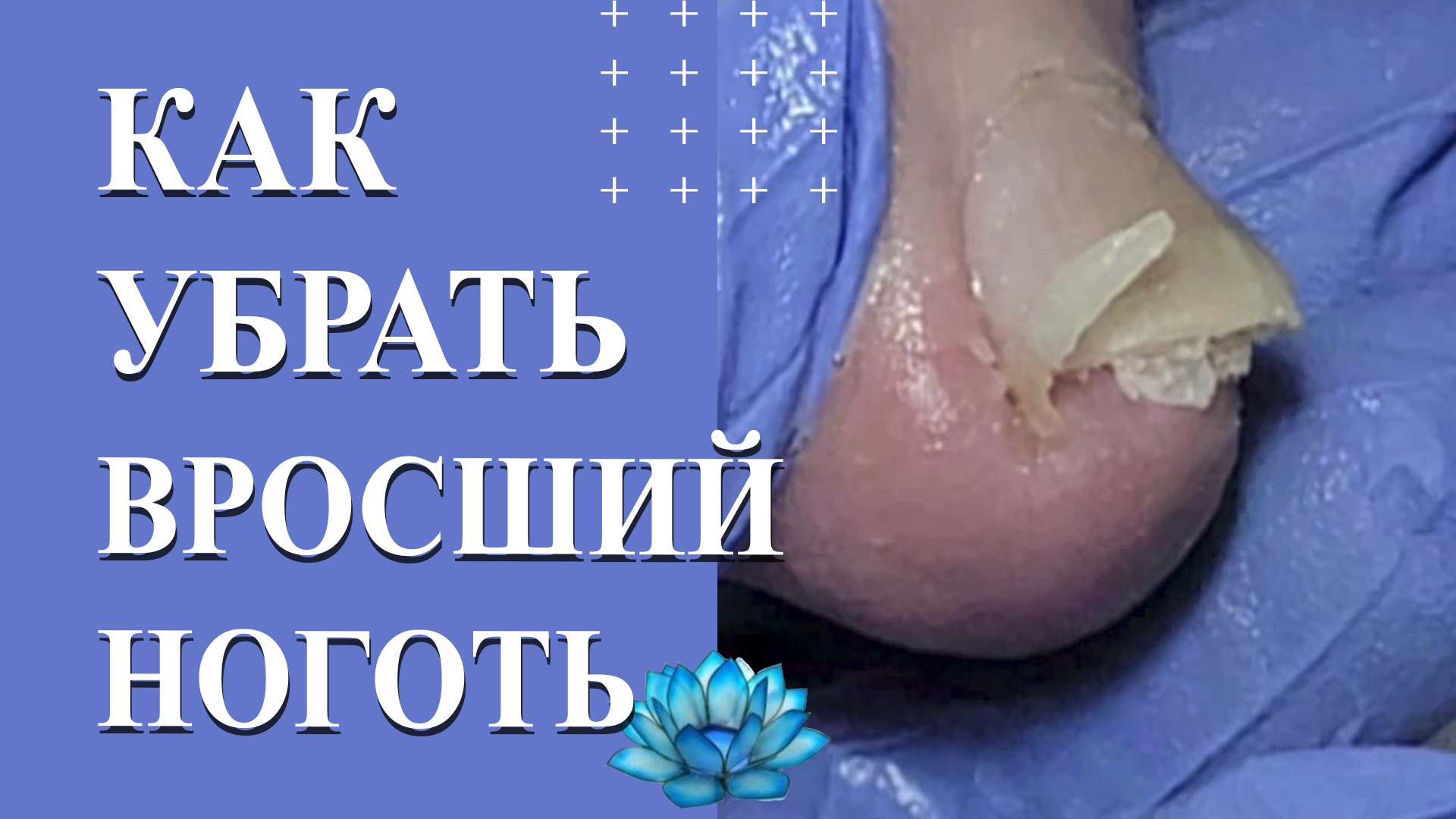 Онихолизис ногтей на ногах. Лечение вросшего ногтя. Скоба фрезера. смотреть онлайн