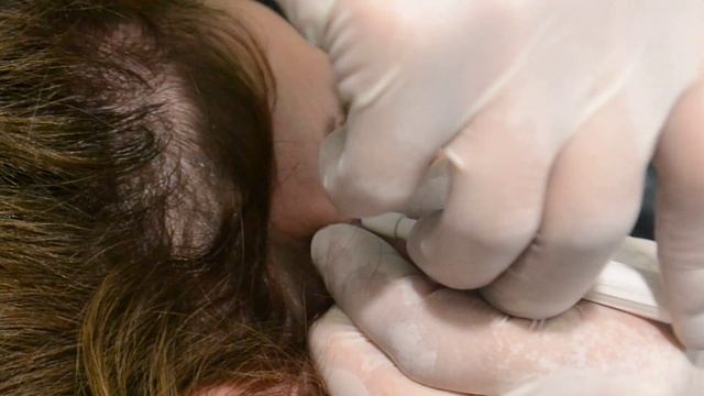 Microdermal implant en tiempo real смотреть онлайн