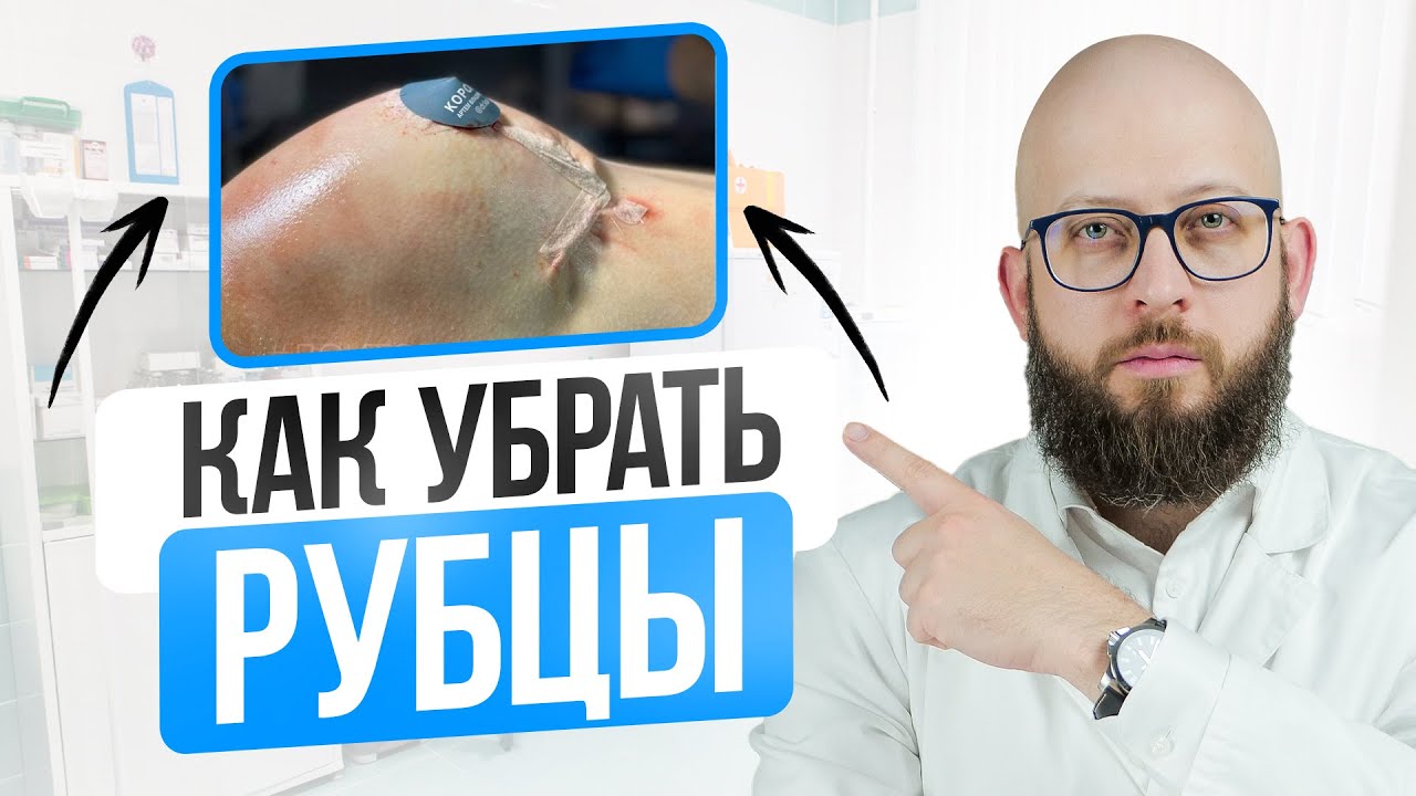 КАК УБРАТЬ РУБЦЫ ПОСЛЕ ОПЕРАЦИИ? Действенные способы. Уход за рубцами после операции смотреть онлайн