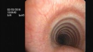 02 03 18 Бронхоскопия