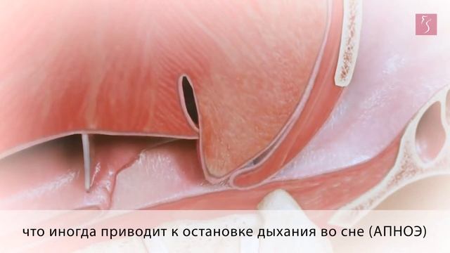Лазерное лечение храпа в Тюмени смотреть онлайн