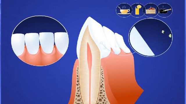 Гигиена и профилактика Образование зубного камня смотреть онлайн