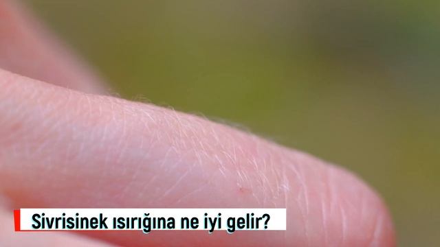 Neden Dişi Sivrisinekler ısırır? Sivrisinek ısırığına Ne Iyi Gelir? Sivrisinek ısırığı Nasıl Geçer?