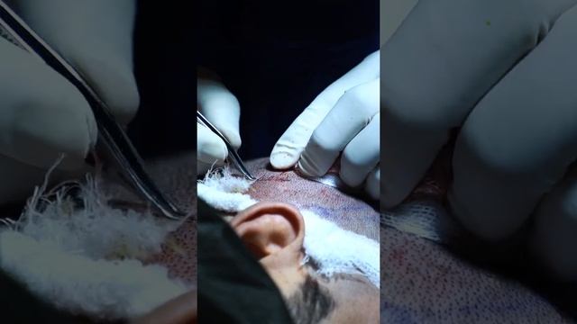 Dr.Hair Este Clinic Fue Saç Ekimi смотреть онлайн
