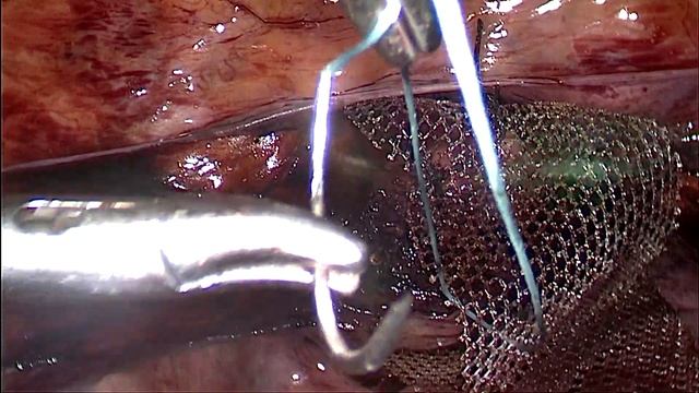Procur PP-H Fixation